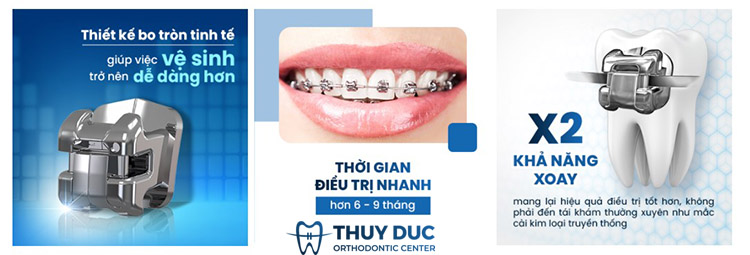 Niềng răng mắc cài kim loại 2