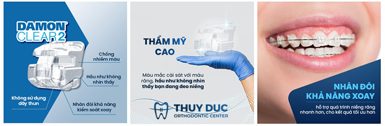Niềng răng mắc cài sứ 1