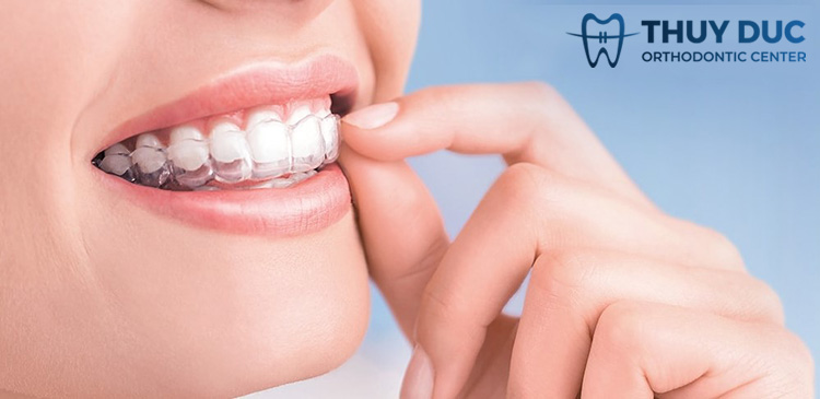 Niềng răng 3 Niềng răng 3