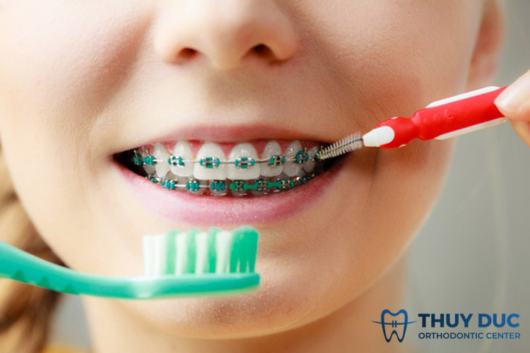 Chăm sóc răng miệng khi niềng răng như thế nào? 1 Chăm sóc răng miệng khi niềng răng như thế nào? 1