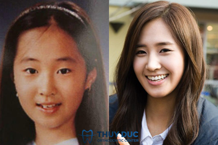 Niềng răng có giúp cho mũi cao hơn không? 7