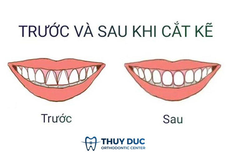 Những trường hợp cần mài kẽ răng khi niềng răng 1