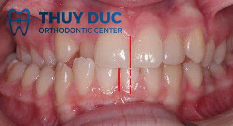 Khớp cắn chéo 1 Khớp cắn chéo 1