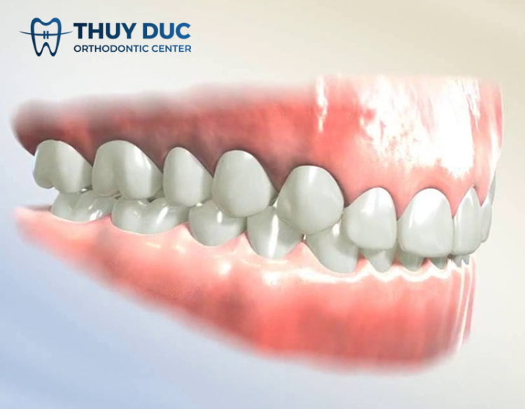 Khớp cắn sâu 1 Khớp cắn sâu 1