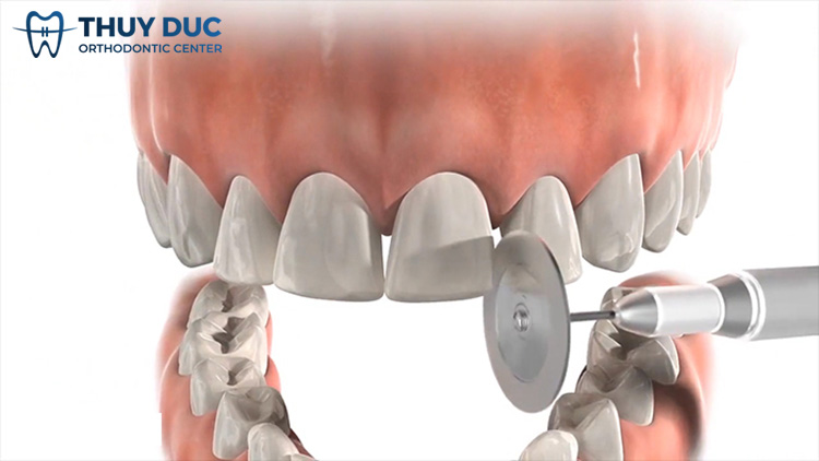 Lựa chọn răng và lượng men cần mài như thế nào? 1