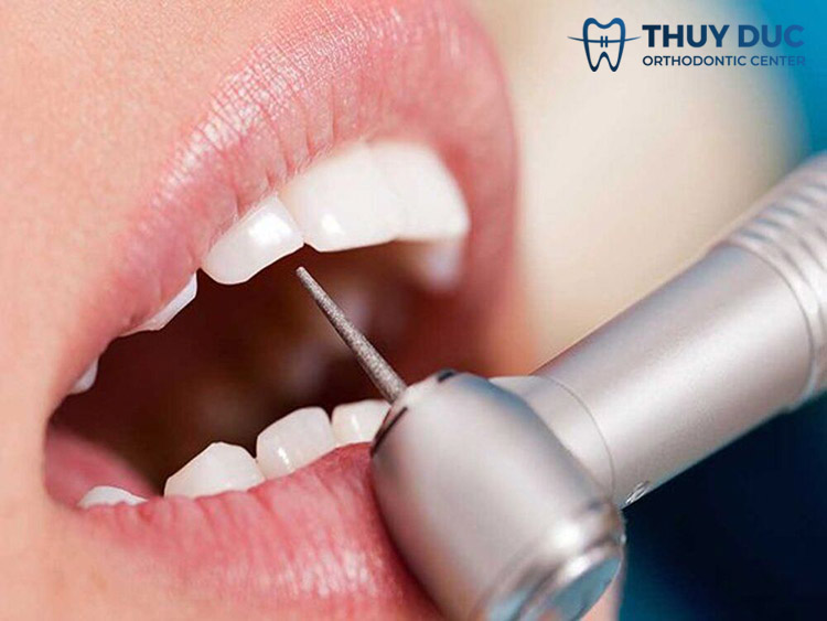 Mài kẽ răng khi niềng răng có đau không? 1