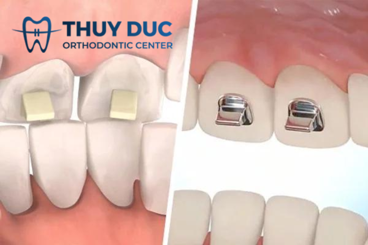 Nâng khớp bằng cục nâng khớp cắn 1 Nâng khớp bằng cục nâng khớp cắn 1