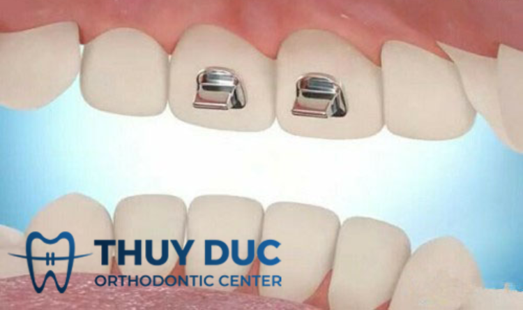 Nâng khớp cắn trong niềng răng là gì? 1 Nâng khớp cắn trong niềng răng là gì? 1