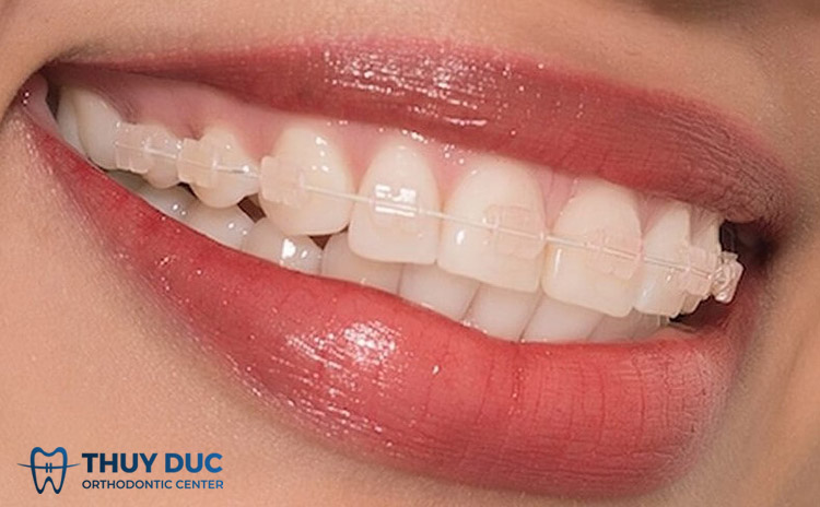 Niềng răng 2 Niềng răng 2
