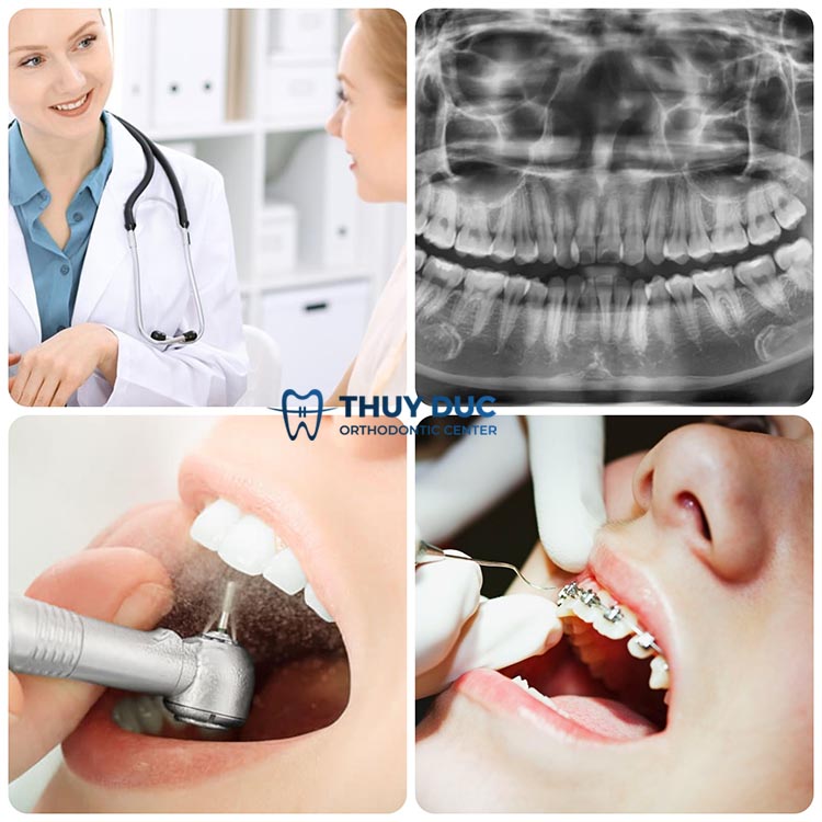 Quy trình mài kẽ răng khi niềng răng chuẩn Y khoa 1