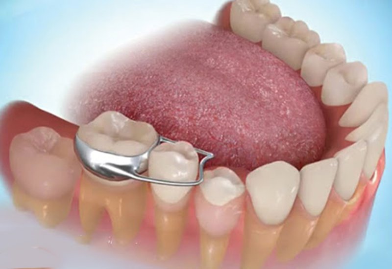 Hàm răng thay đổi như thế nào sau khi gắn band niềng răng? 1