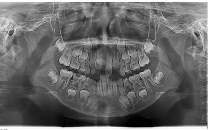 Quy trình chụp phim X - quang trước khi niềng răng 1 Quy trình chụp phim X - quang trước khi niềng răng 1