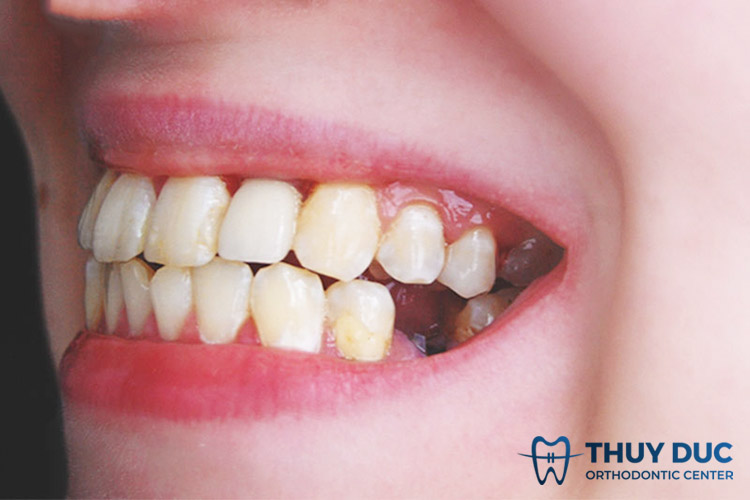 Hậu quả của răng bị nghiêng ra sao? 1 Hậu quả của răng bị nghiêng ra sao? 1