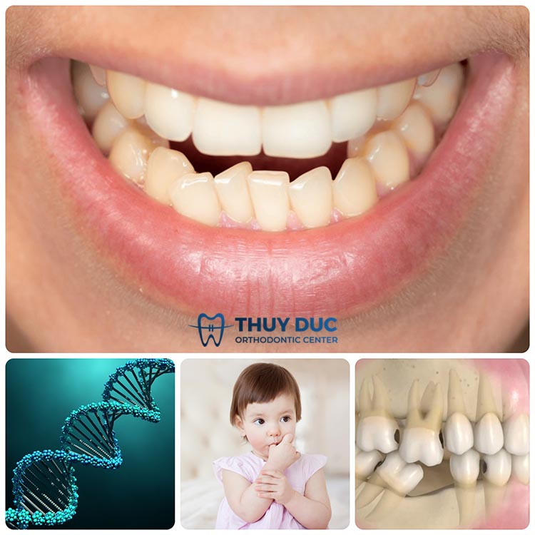 Những nguyên nhân dẫn tới răng bị nghiêng 1 Những nguyên nhân dẫn tới răng bị nghiêng 1