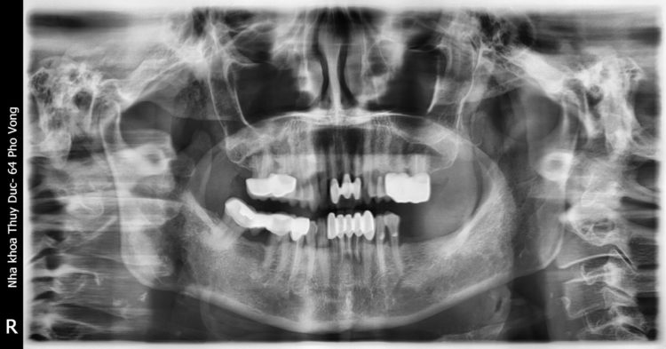 Chụp X - quang răng là gì? Tại sao cần chụp X - quang khi niềng? 2 Chụp X - quang răng là gì? Tại sao cần chụp X - quang khi niềng? 2