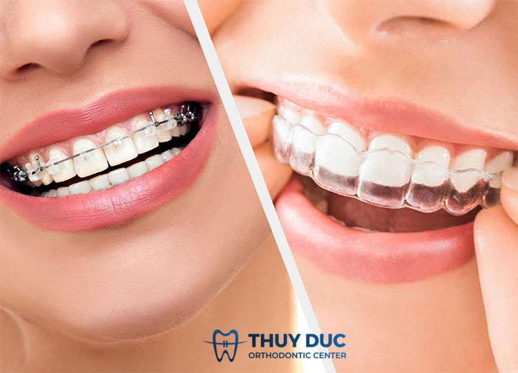 Tìm hiểu về phương pháp niềng răng 1 Tìm hiểu về phương pháp niềng răng 1