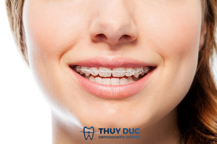 Niềng răng mắc cài sứ 1 Niềng răng mắc cài sứ 1