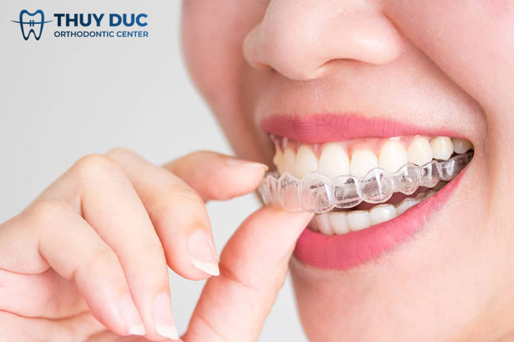Niềng răng trong suốt Invisalign 1 Niềng răng trong suốt Invisalign 1