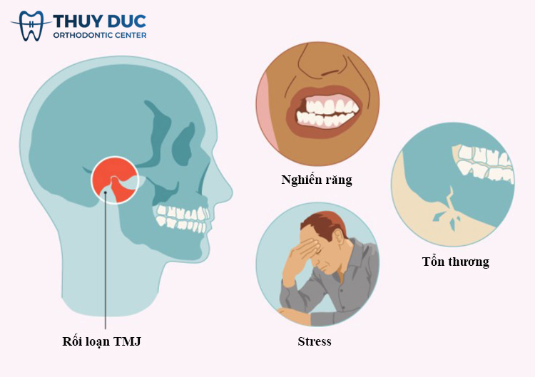 Chẩn đoán rối loạn khớp thái dương hàm 1 Chẩn đoán rối loạn khớp thái dương hàm 1
