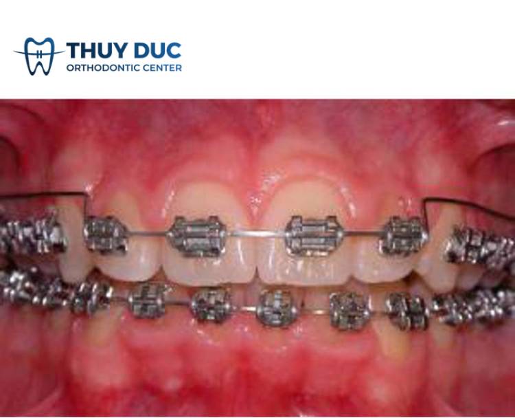 Đánh lún răng bằng dây cung 1