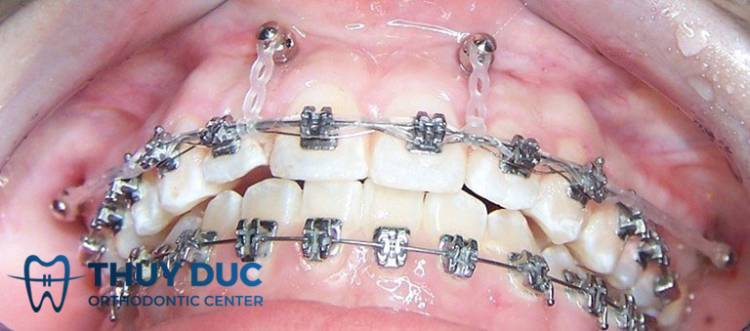 Đánh lún răng bằng minivis 1