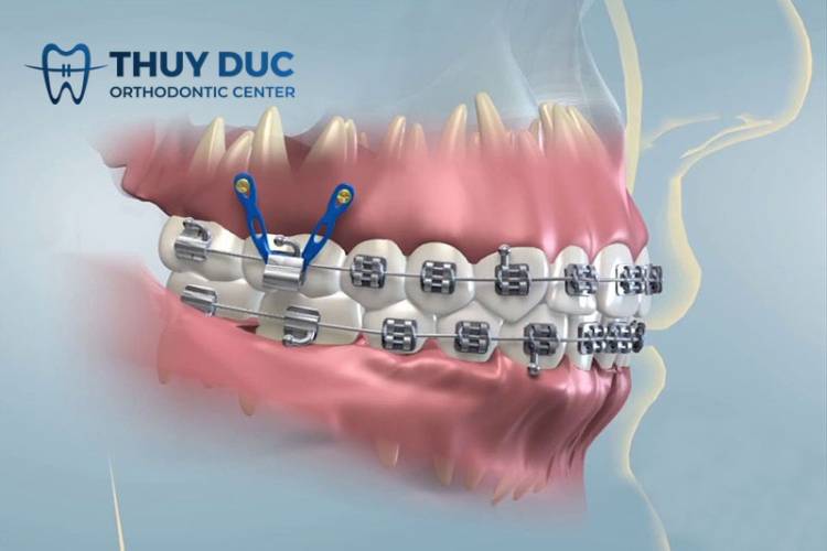 Đánh lún răng là gì? Khi nào cần thực hiện? 1