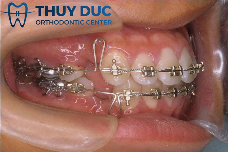 Giai đoạn đóng khoảng 1