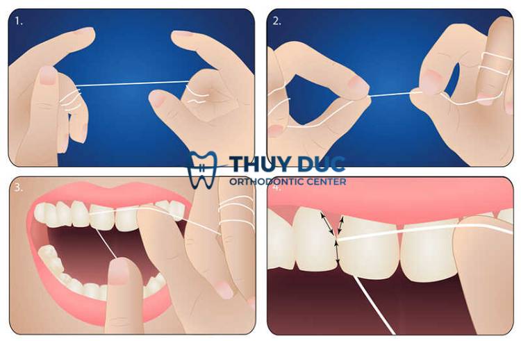 Hướng dẫn sử dụng chỉ nha khoa đúng cách cho người niềng răng 1