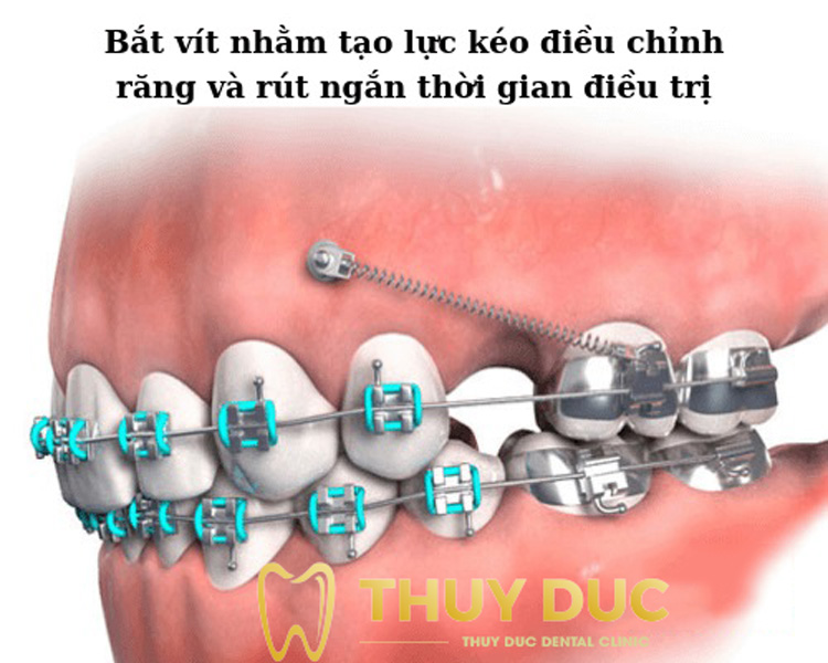 Sử dụng móc kéo 1