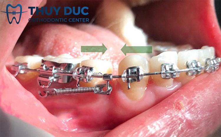 Kéo khoảng trong niềng răng có thể tái phát sau khi quá trình niềng răng hoàn thành?

