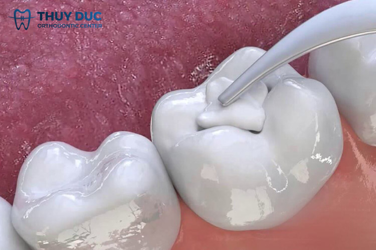 Điều trị răng sâu nhẹ 1 Điều trị răng sâu nhẹ 1