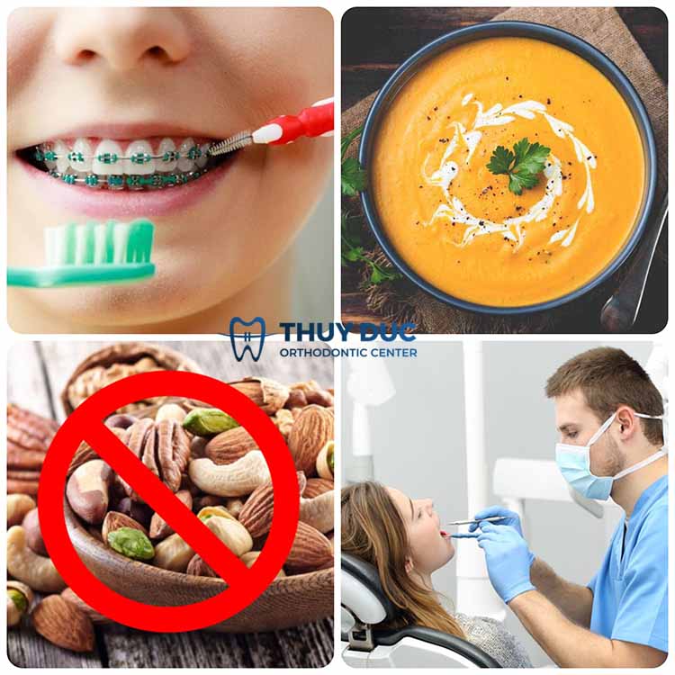 Hướng dẫn cách phòng tránh sâu răng khi niềng răng 1 Hướng dẫn cách phòng tránh sâu răng khi niềng răng 1