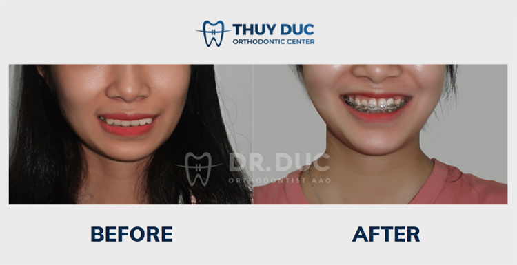 Niềng răng với mắc cài thông minh Damon Hoa Kỳ 9