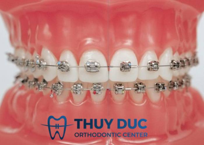 Tìm hiểu về mắc cài kim loại 3M 1 Tìm hiểu về mắc cài kim loại 3M 1