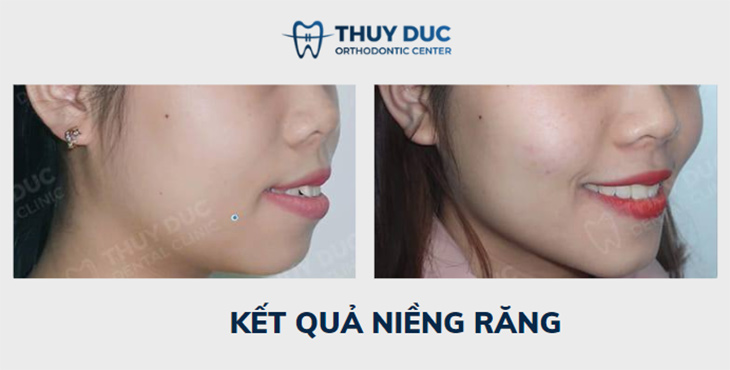 Niềng răng với mắc cài thông minh Damon Hoa Kỳ 11