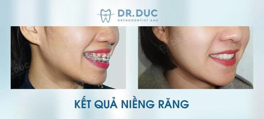 Niềng răng với mắc cài thông minh Damon Hoa Kỳ 4