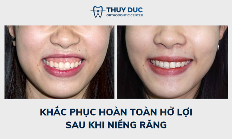 Niềng răng với mắc cài thông minh Damon Hoa Kỳ 6