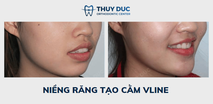 Niềng răng với mắc cài thông minh Damon Hoa Kỳ 8