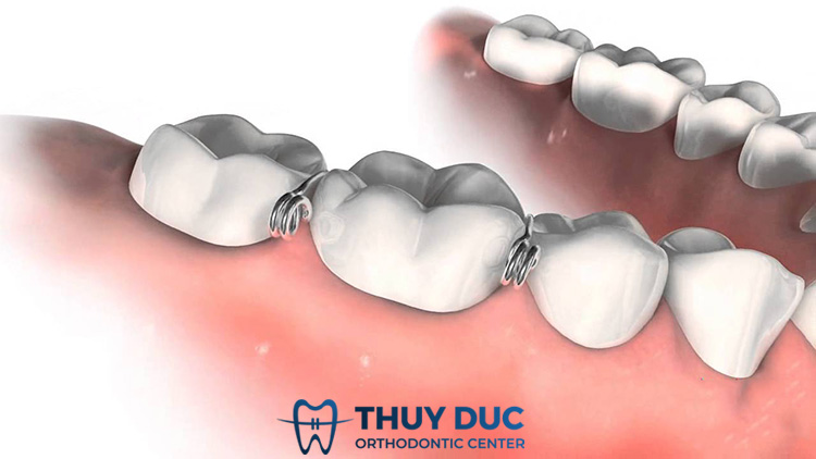 Thun tách kẽ kim loại 1 Thun tách kẽ kim loại 1