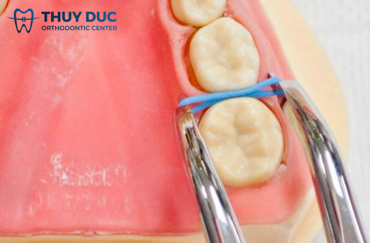 Cách 2: Sử dụng kiềm 1 Cách 2: Sử dụng kiềm 1