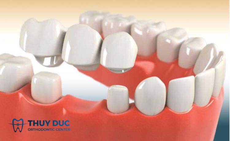 Tìm hiểu phương pháp làm cầu răng sứ 1 Tìm hiểu phương pháp làm cầu răng sứ 1