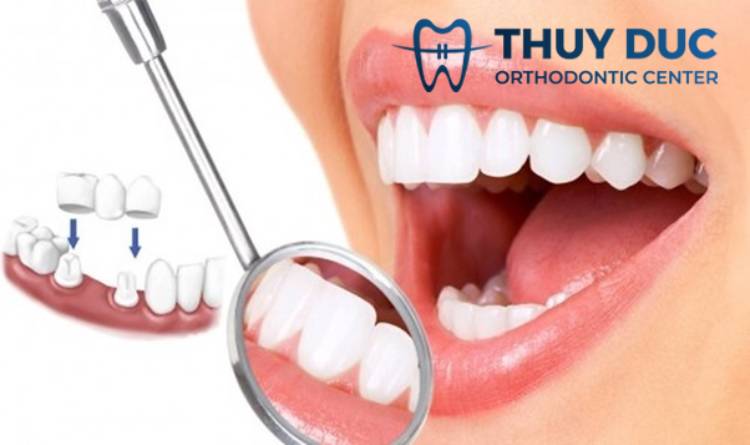 Làm cầu răng sứ có niềng răng được không? 1 Làm cầu răng sứ có niềng răng được không? 1