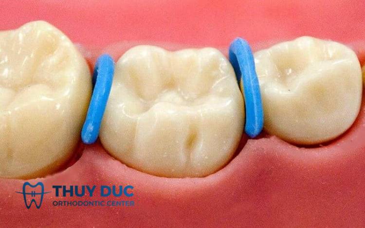 Tại sao phải đặt thun tách kẽ khi niềng răng? 1