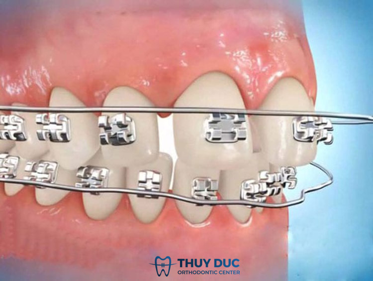 Mắc cài bị bong tuột có ảnh hưởng gì không? 1 Mắc cài bị bong tuột có ảnh hưởng gì không? 1