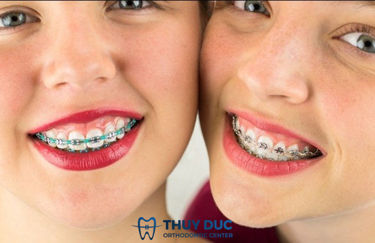 Những trường hợp nào cần đeo thun chuỗi? 1 Những trường hợp nào cần đeo thun chuỗi? 1