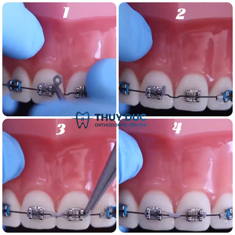 Cách đeo thun chuỗi giữa hai răng 1 Cách đeo thun chuỗi giữa hai răng 1