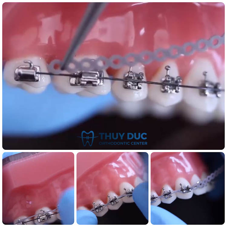 Cách đeo thun chuỗi giữa nhiều răng 1 Cách đeo thun chuỗi giữa nhiều răng 1