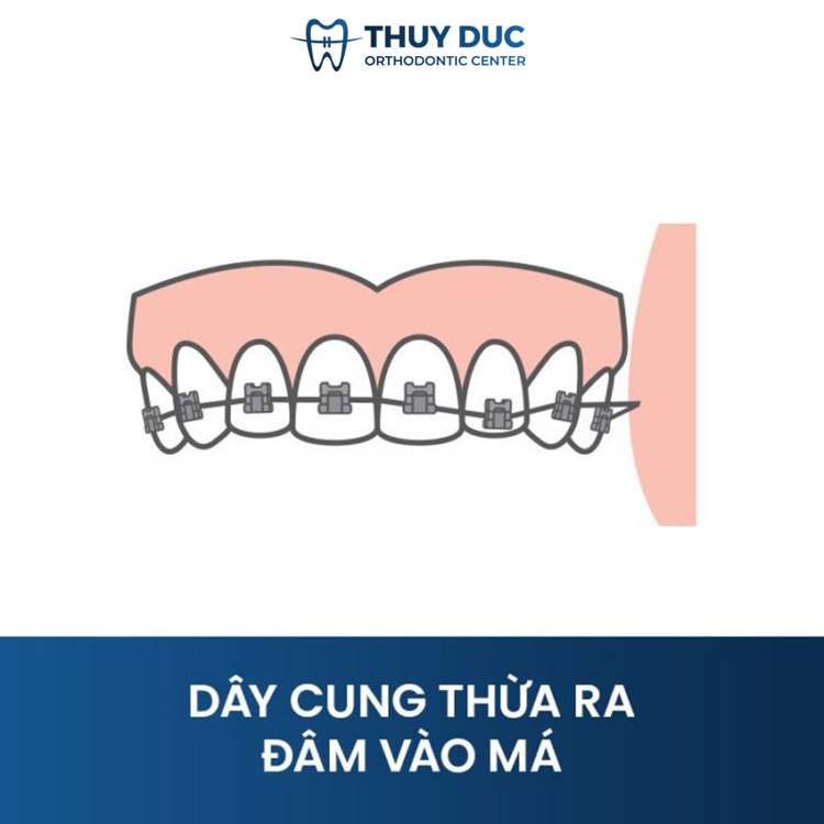 Có những cách điều trị nào để giảm đau và viêm khi bị dây cung niềng răng đâm vào má?
