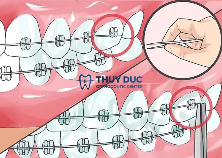 Cách sửa dây cung hiệu quả 1 Cách sửa dây cung hiệu quả 1