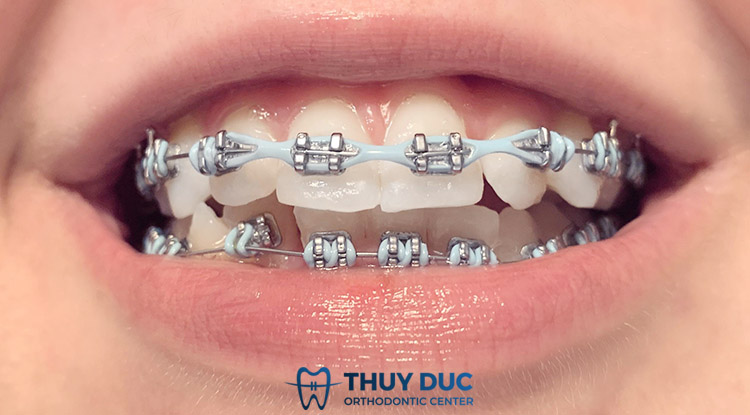 Giải đáp thun chuỗi trong niềng răng là gì? 1 Giải đáp thun chuỗi trong niềng răng là gì? 1